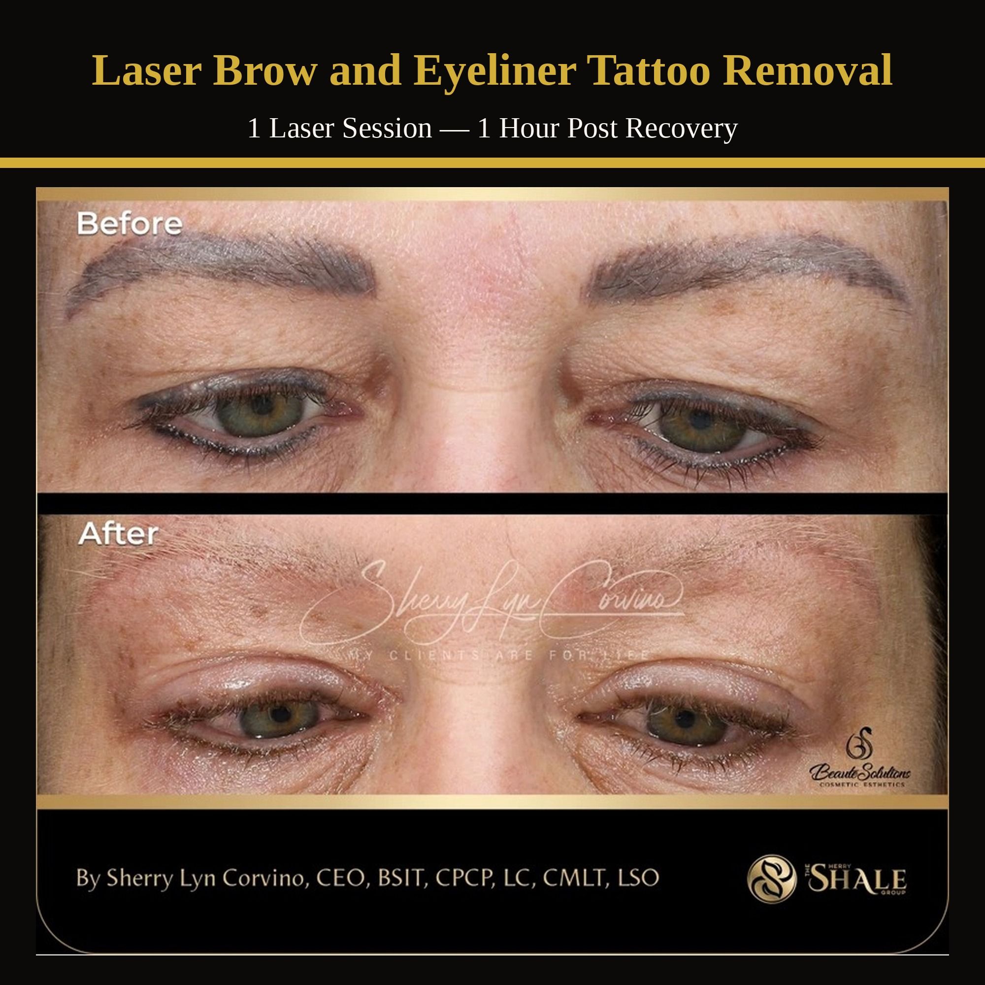Laser brow and eyeliner tattoo removal — 1 session, 1 hour post recovery