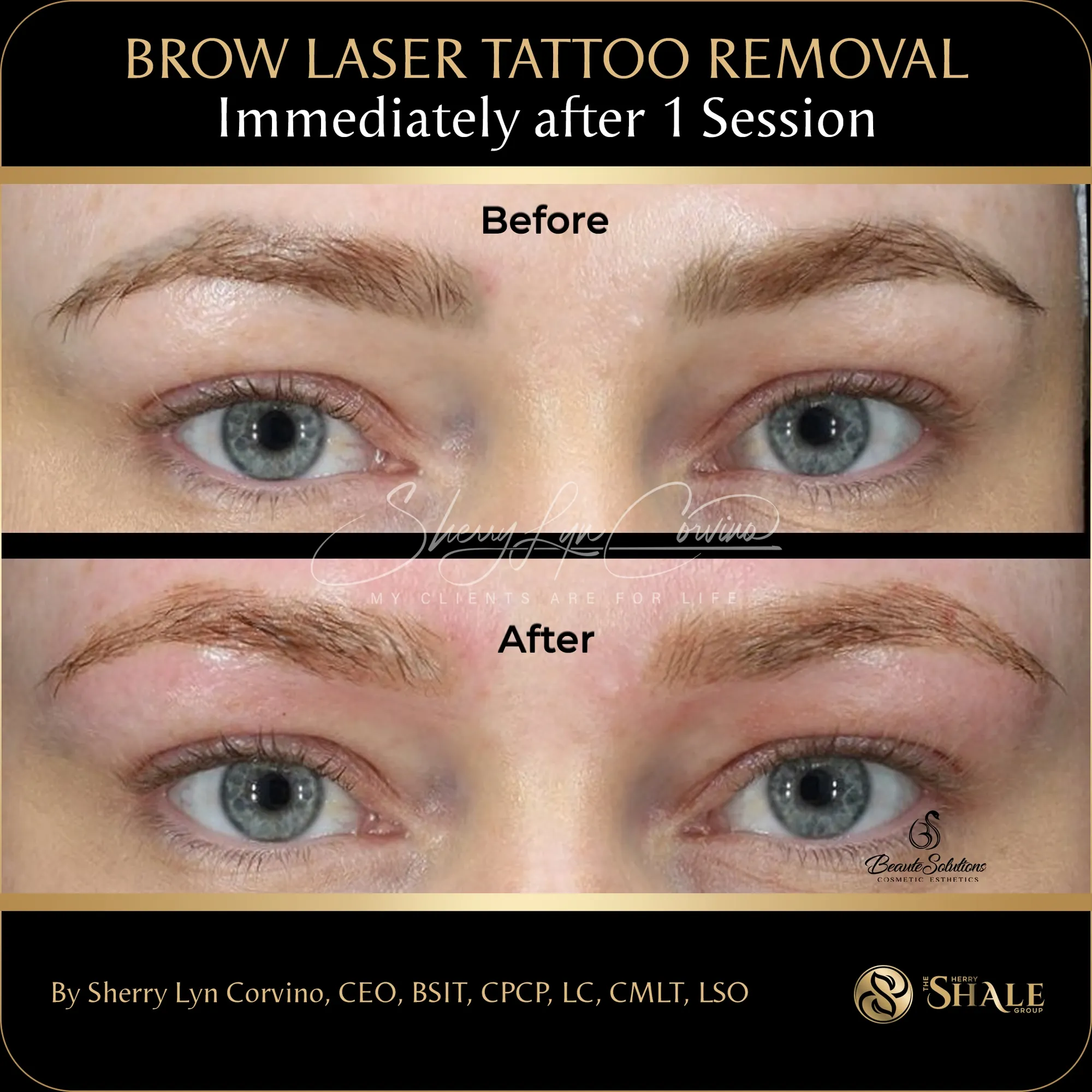 Brow laser tattoo removal — immediately after 1 session
