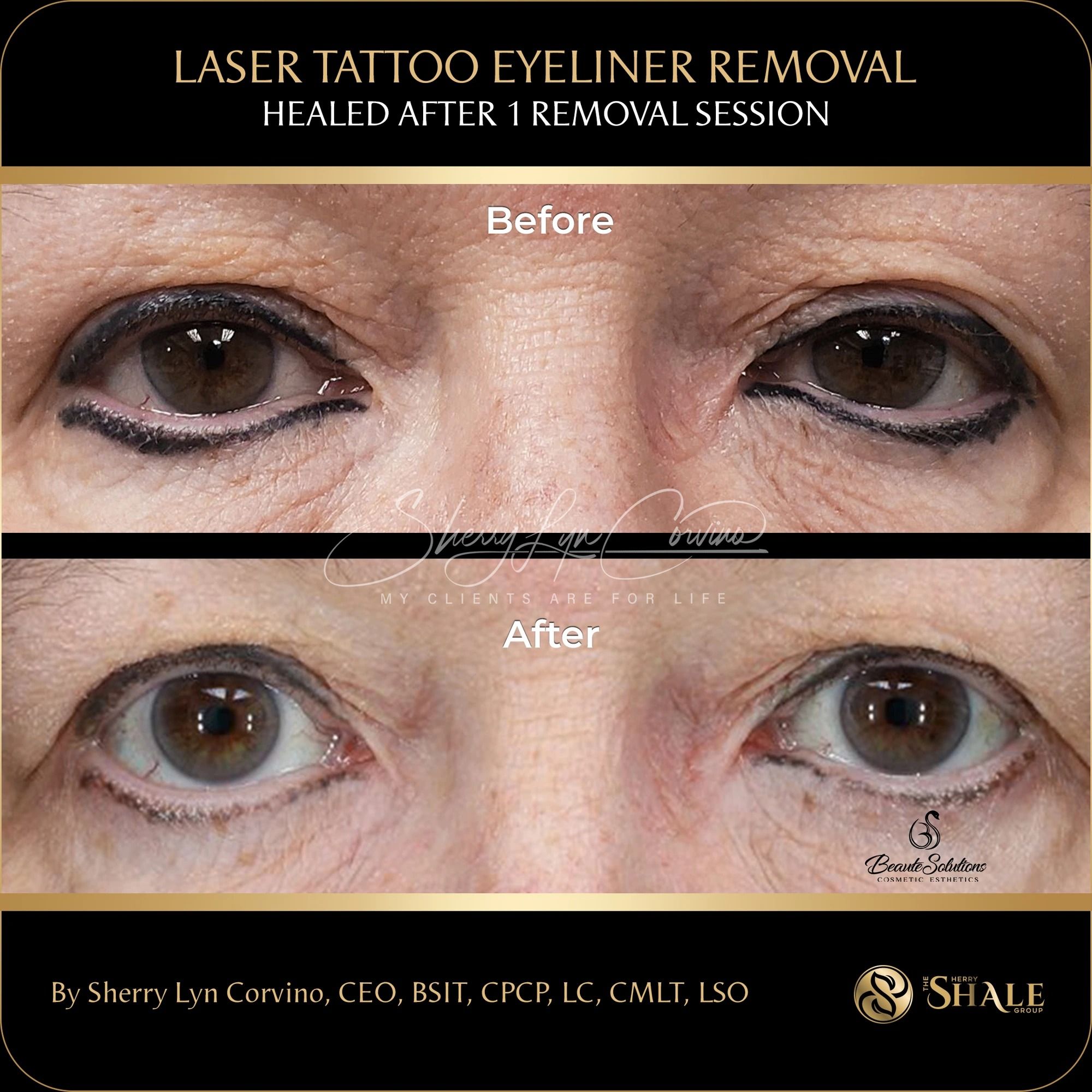 Laser tattoo eyeliner removal — healed after 1 removal session