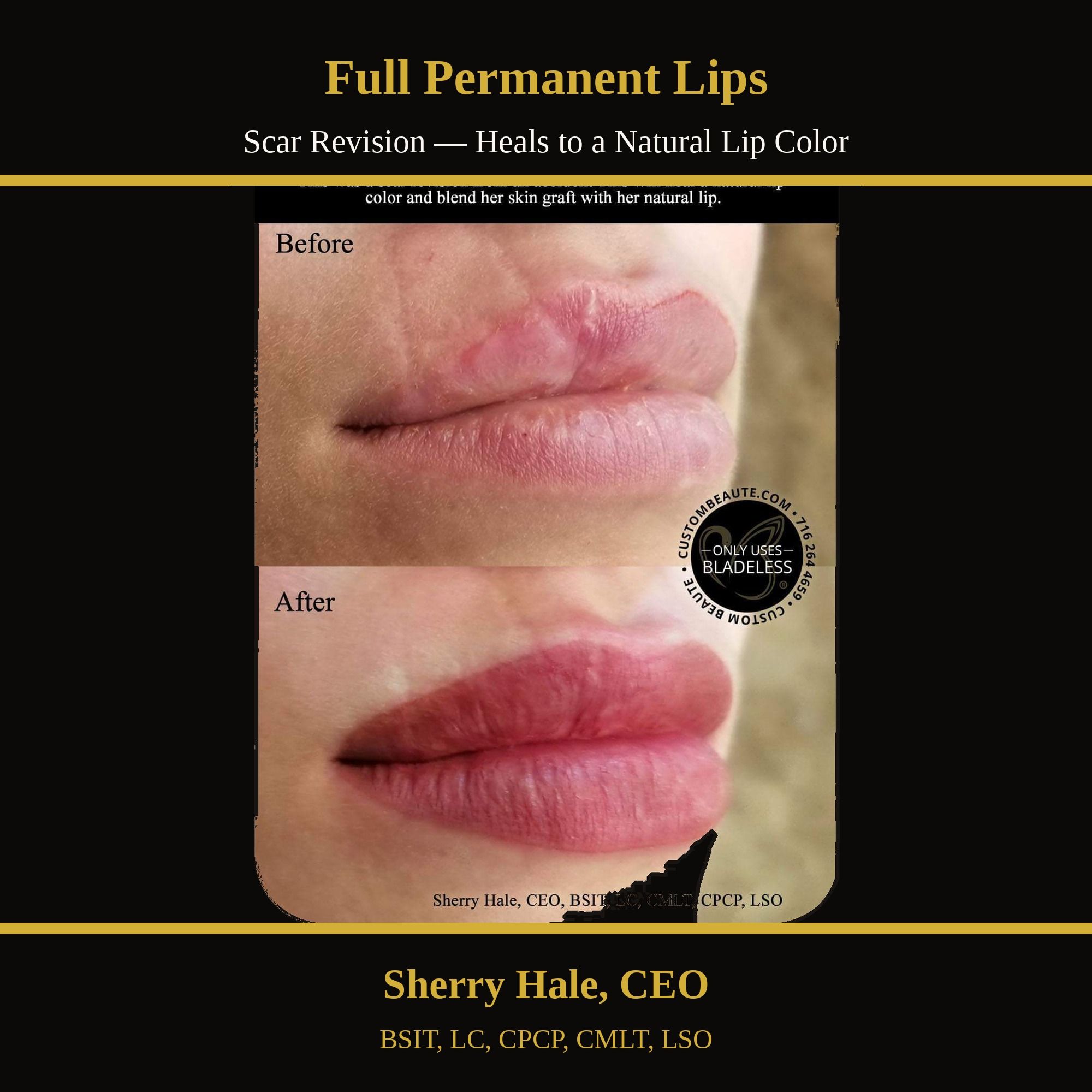 Full permanent lips — scar revision, natural lip color