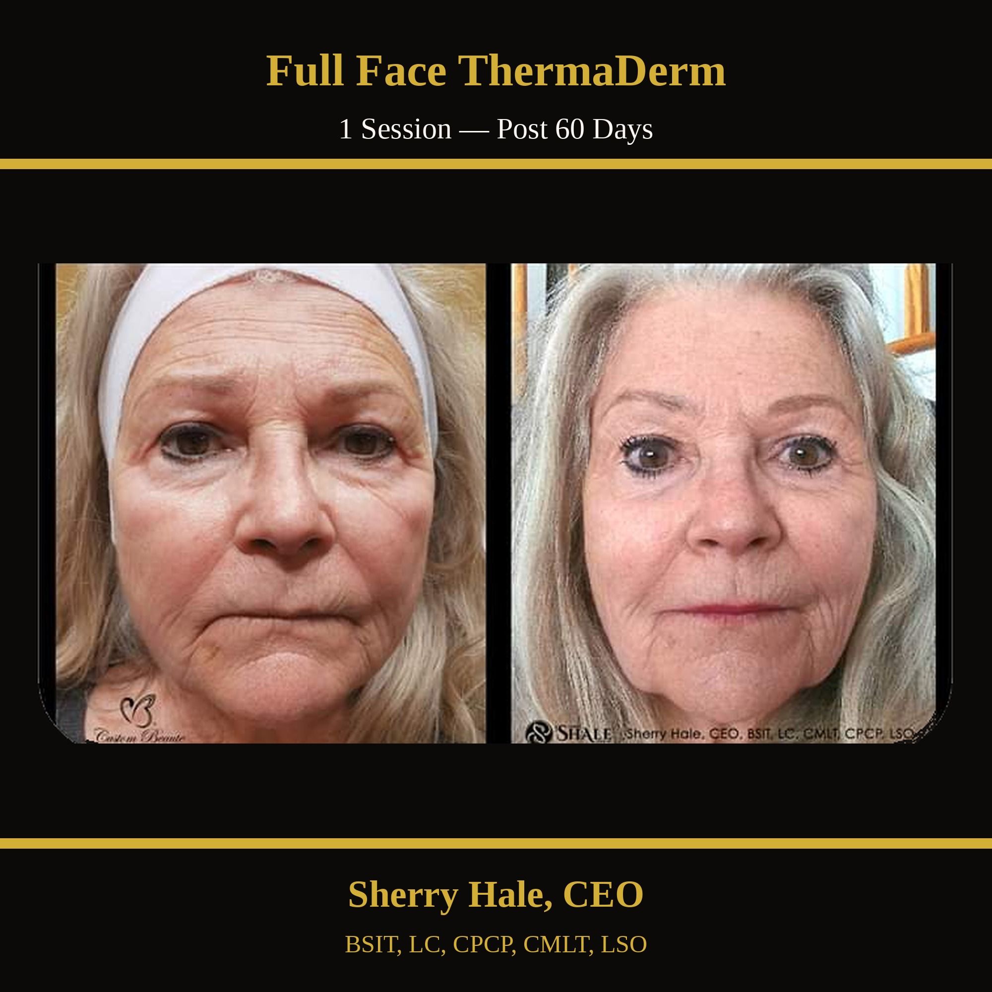 Full-face ThermaDerm — 1 session, post 60 days