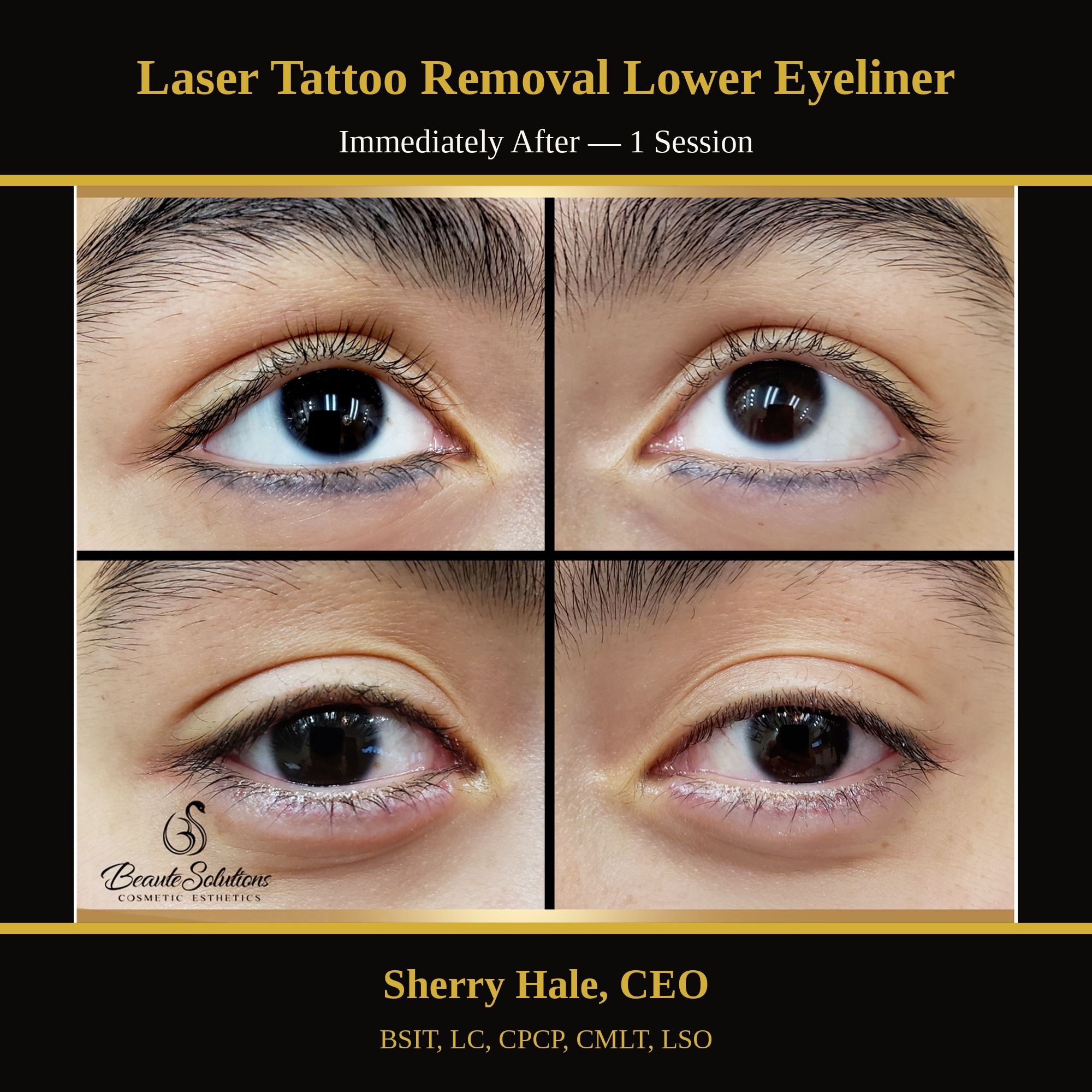 Laser tattoo removal lower eyeliner — immediately after 1 session