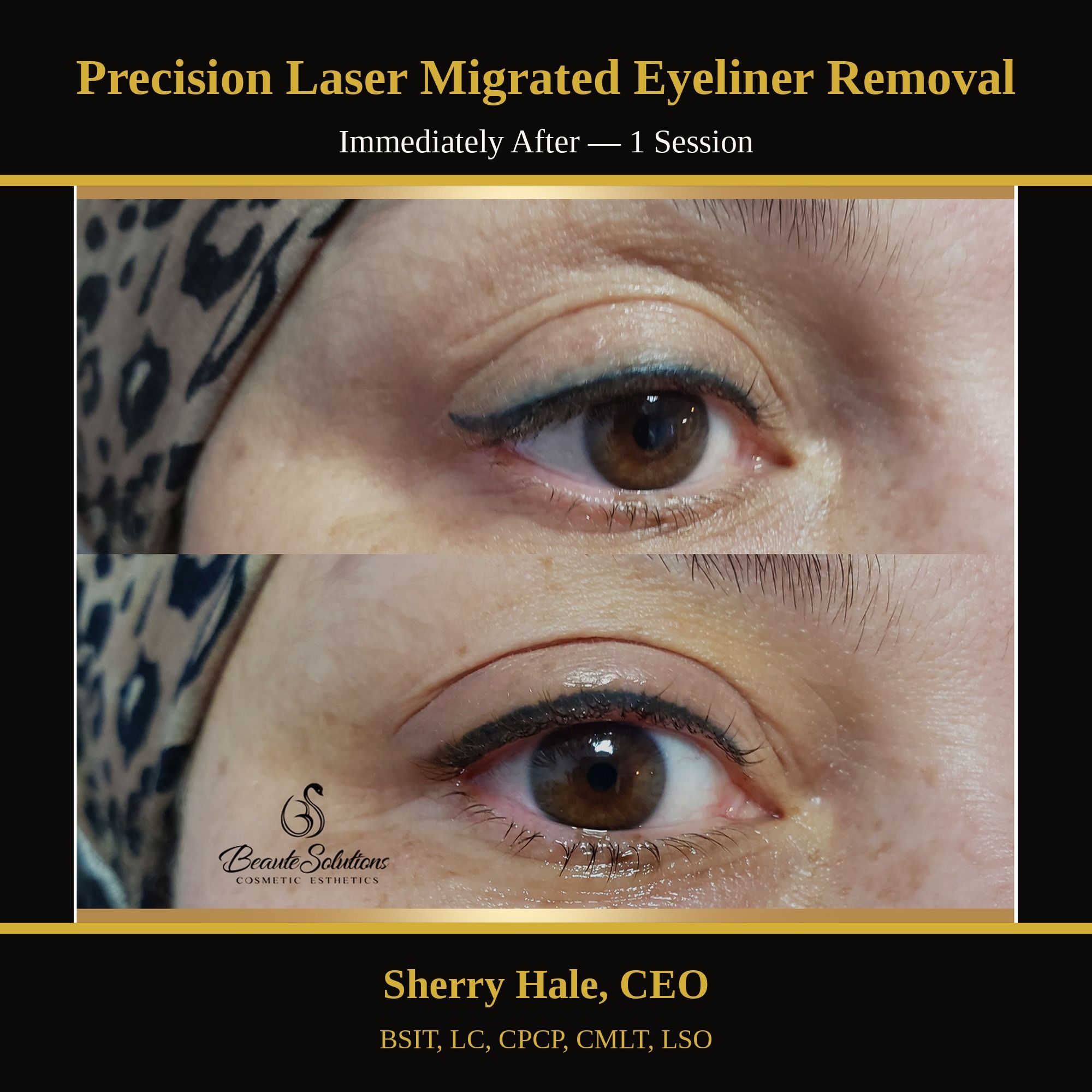 Precision laser migrated eyeliner removal — immediately after 1 session