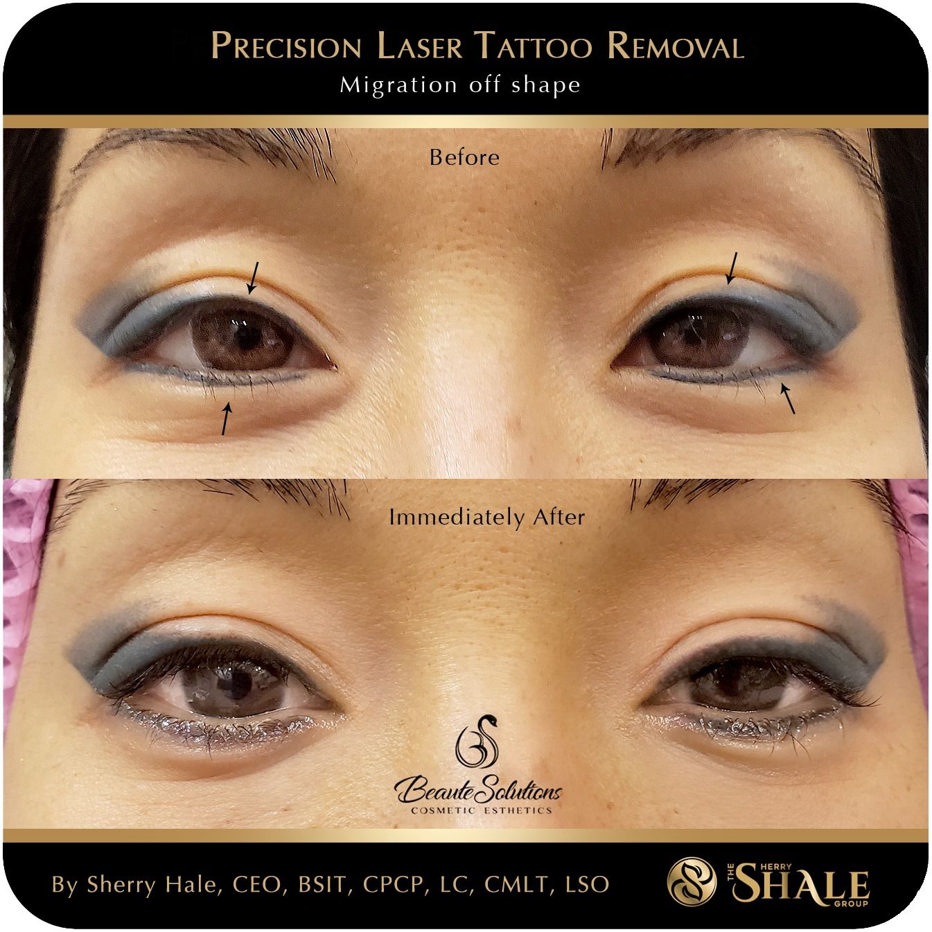 Precision laser tattoo removal — migration off shape