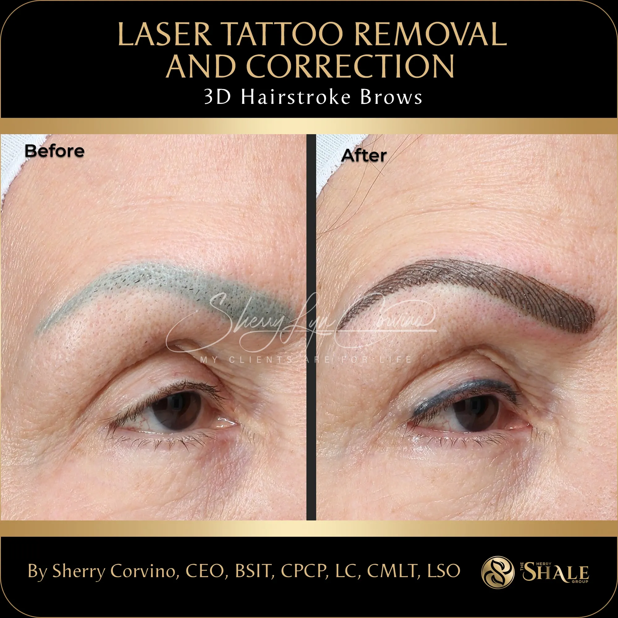 Laser tattoo removal & correction — 3D hairstroke brows