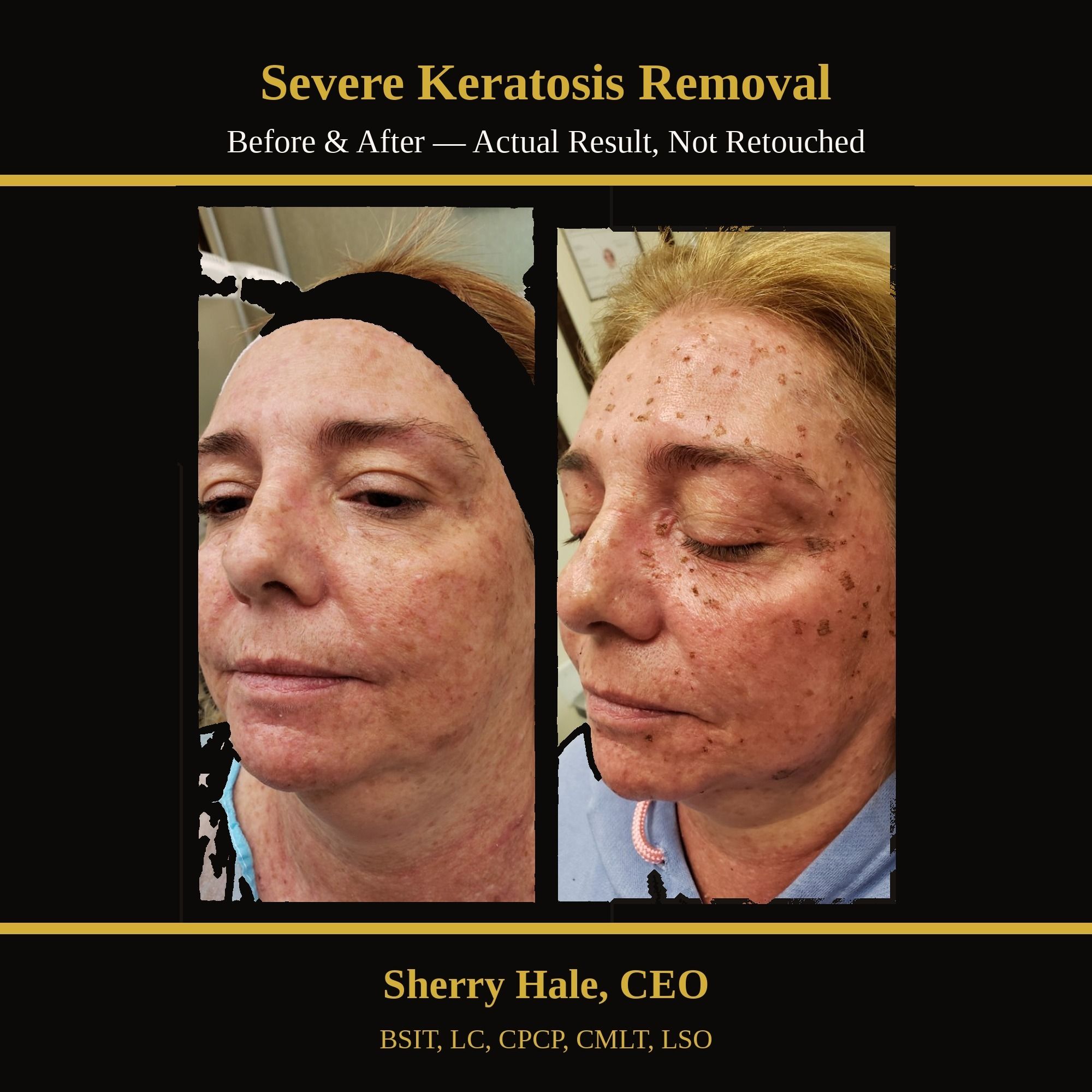 Severe keratosis removal — actual result, not retouched