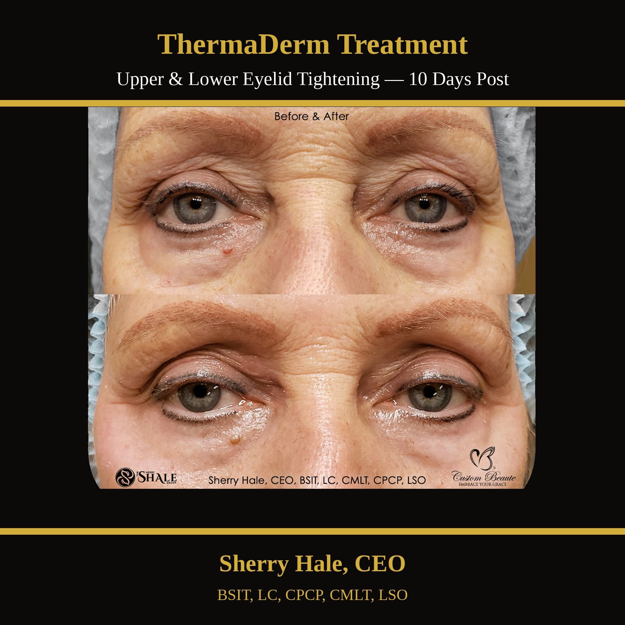 ThermaDerm treatment — upper & lower eyelid tightening, 10 days post