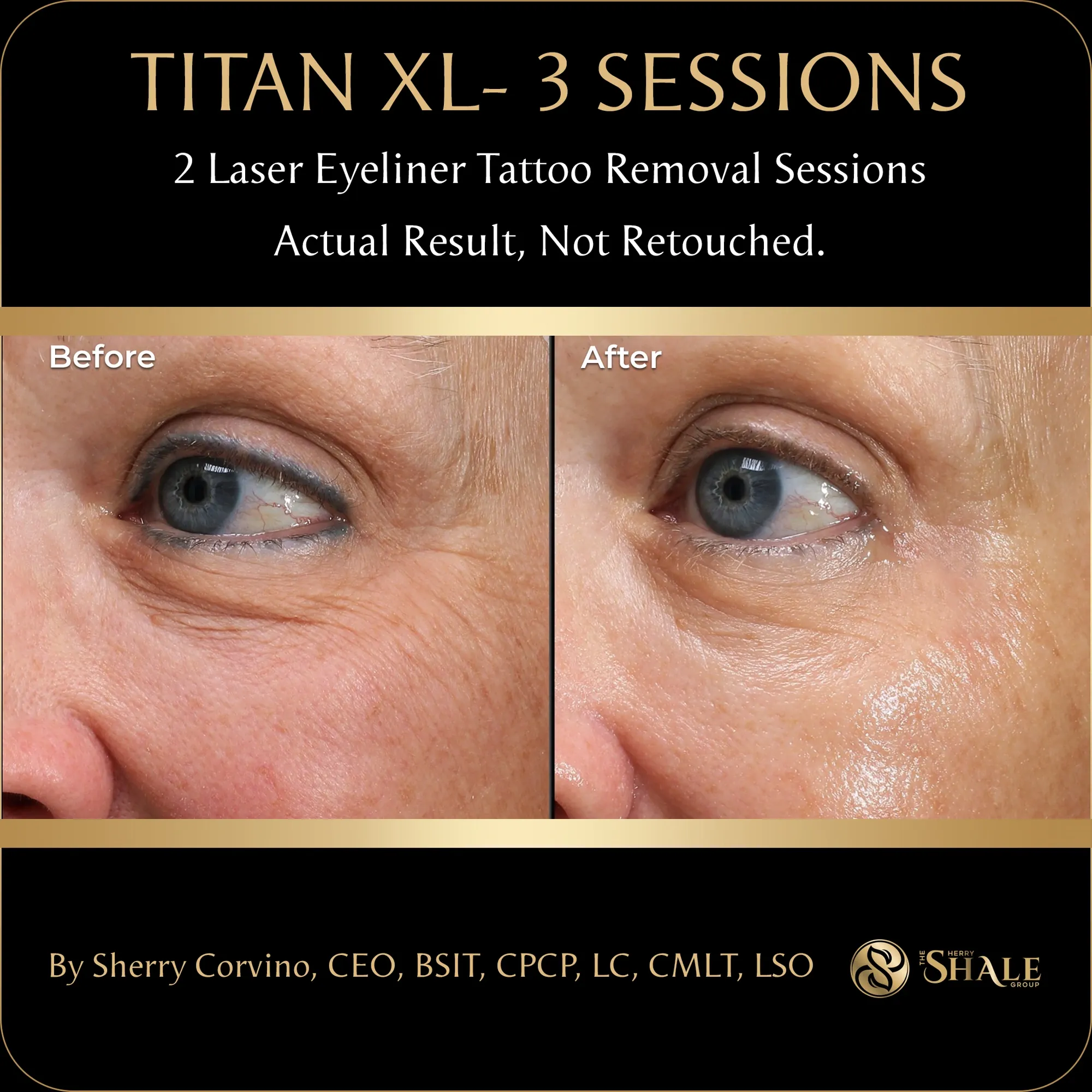 Titan XL, 3 sessions + 2 laser eyeliner removal sessions — actual result, not retouched